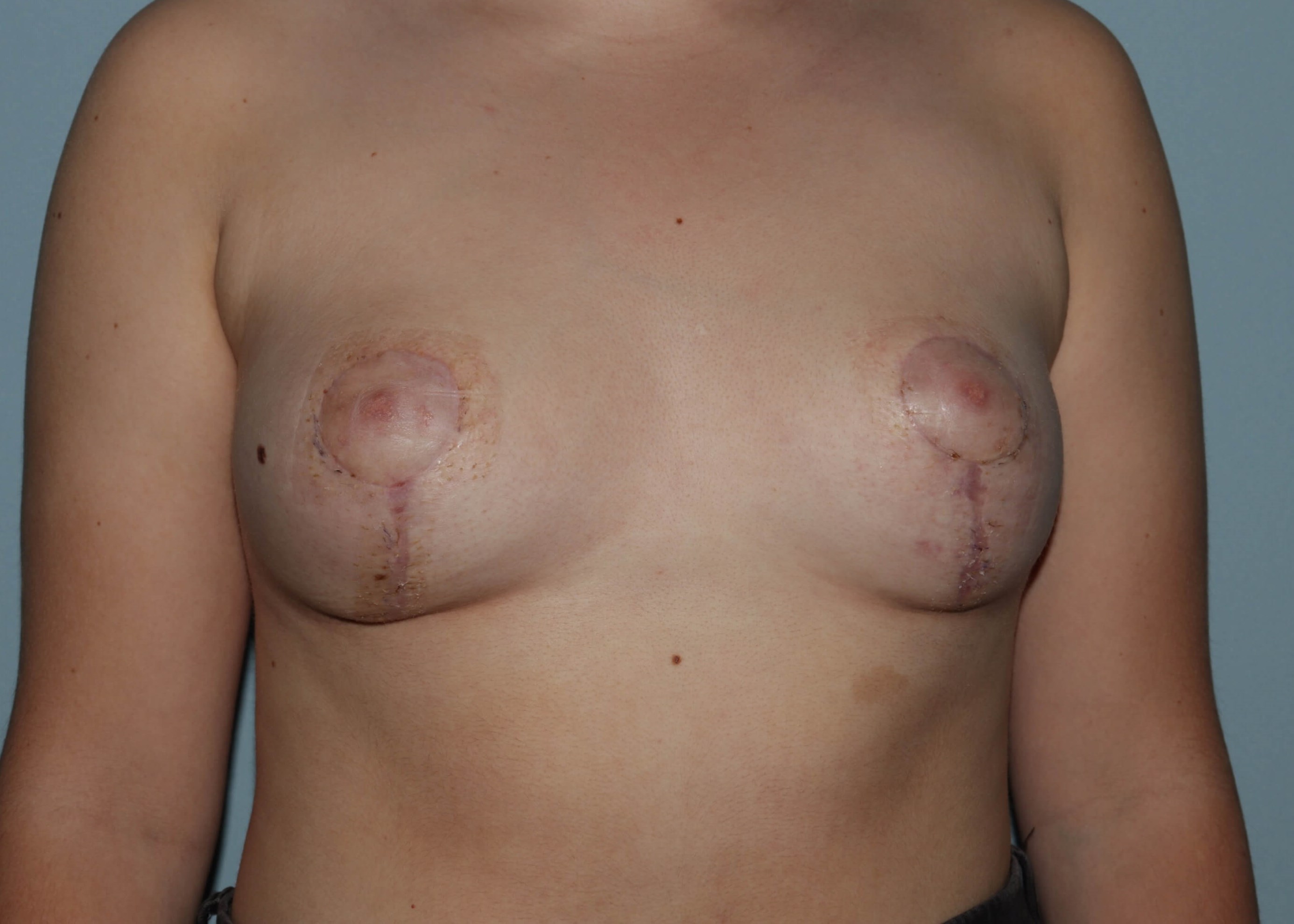 Postop after mastopexy
